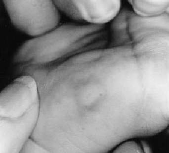 Mastocitoma. Hannaford R, Rogers M. Presentation of cutanous mascotcytosis in 173 children. Austr J of Dermatology 2001, 42:15-21.