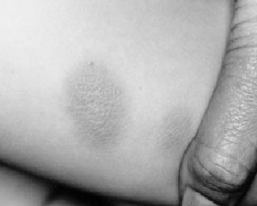 Mastocitoma. Hannaford R, Rogers M. Presentation of cutanous mascotcytosis in 173 children. Austr J of Dermatology 2001, 42:15-21.