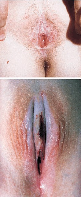 Liquen escleroso y atrofico en nias prepuberales. Lancet 1999; 353: 1777-83 