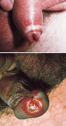 Liquen escleroso y atrofico en el varon. La fotosuperior muestra la esclerosis y fimosis. La foto inferor muestra una lesion erosiva que mejoro tras la aplicacin de esteroides topicos.  Lancet 1999; 353: 1777-83 