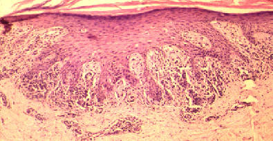 Biopsia cutnea de un liquen plano. Se observa hiperplasia epidrmica en dientes de sierra con hiperqueratosis e hipergranulosis, asi com infiltrados dermicos linfocitarios dispuestos en banda y afectando a la unin dermo-epidermica.