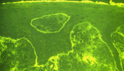 Inmunofluorescencia directa mostrando depositos de fibrinogeno en la unin dermo-epidermica