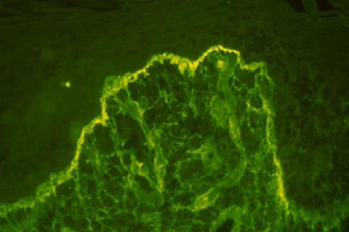 Inmunofluorescencia del liquen plano mostranod depositos de fibrinogeno en la unin dermo-epidermica (Atlas de dermatologia pediatrica)
