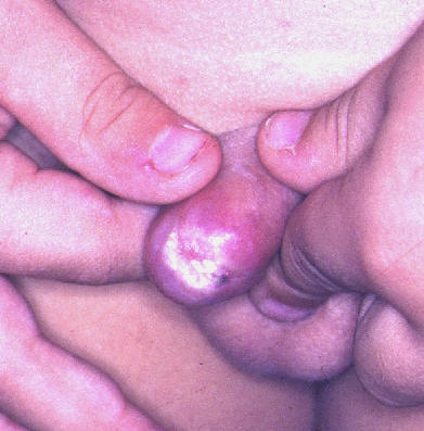 Liquen escleroso y atrofico en prepucin con formacin de un anillo esclertico.