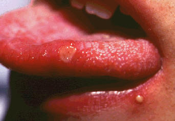 Afta oral de menos de 1 cm, cubierta de una membrana serosa amarillenta