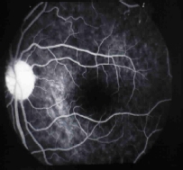 Angiografia con fluoresceina del ojo izquierdo