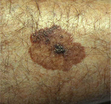queratosis seborreica