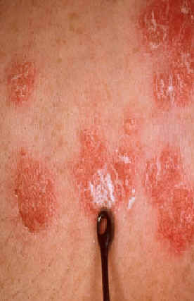 signo de Auspitz. El rascado metdico de las escamas que cubren las placas de psoriasis dejan al descubierto un rea eritematosa en la que se observan pequeos puntos hemorrgicos.