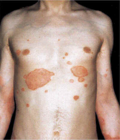 Psoriasis leve