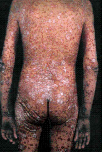 psoriasis severa