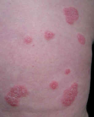 placas eritematosas, bien delimitadas con discreta descamacin en la superficie, caractersticas de la psoriasis vulgar