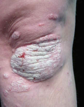 placa eritemtosa cubierta de una gruesa escama plateada localizada en rodilla, caracterstica de la psoriasis vulgar