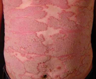 Mltiples placas eritematosas bien delimitadas de la piel normal cubiertas de escamas, caracteristicas de una psoriasis en placas extensa