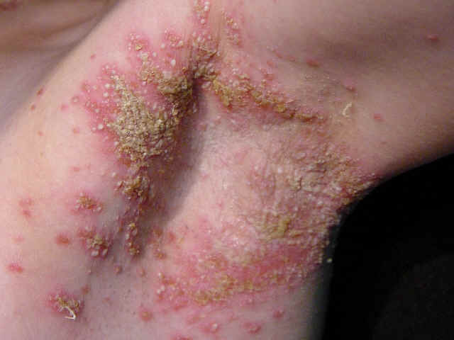 Paciente con antecedentes personales de psoriasis vulgar que desarrolla de forma brusca lesiones inflamatorias de distribucin simetrica afectando a axilas, ingle y cara lateral de cuello. La exploracin revelo placa eritematosa con mltiples pstulas. El examen directo  y  KOH del contenido de las pustulas fue negativo asi como el cultivo. El estudio histolgico revelo cambios consistentes con psoriasis pustulosa.