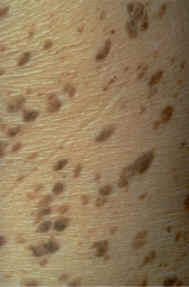 mltiples queratosis seborreicas en torax