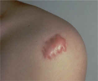 queloide en hombro(AAD)