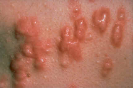 Mltiples queloide (AAD)