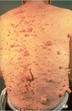 neurofibromatosis (AAD)