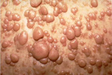 Neurofibromatosis (AAD)