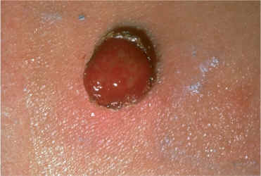 imagen de granuloma piogenico
