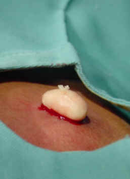 La realizacin de una pequea incisin permite la extirpacin del quiste con observacin de una cpsula blanca brillante y de contenido queratsico y aspecto graso