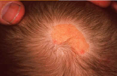 Nevus seb�ceo. Se trata de un tumor localizado preferentemente en el cuero cabelludo y que est� presente desde el nacimiento mostrandose como una placa de alopecia que con el curso de los a�os presenta un desarrollo verrucoso, de color amarillento y en un porcentaje alto de casos en la edad adulta desarrolla un carcinoma basocelular o un siringocistoadenoma papilifero. imagen de Lachapelle JM. Atlas de dermatologia. UCB pharmaceuticals.