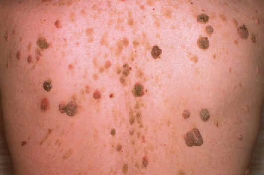 queratosis seborreicas mltiples en torax. Lachapelle JM. Atlas de dermatologa. UCB pharmaceuticals.