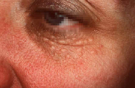 Siringomas. Lesiones papulares m�ltiples afectando de forma sim�trica a ambas regiones infraorbitarias. Lachapelle JM: Atlas de Dermatologia. UCB pharmaceuticals.