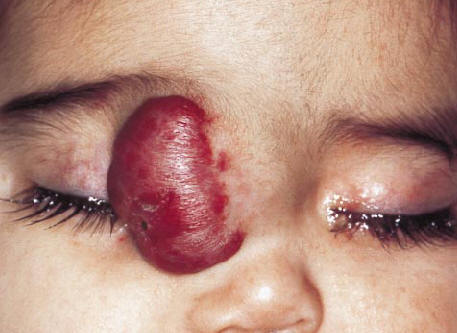Nia con un hemangioma priorbitario, dado que afecta al eje visual tiene riesgo de desarrollar una ambliopia. North PE. Arch Dermatol 2001, 137:559.
