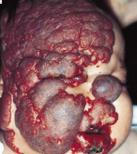 Nio con un hemangioma muy grande afectando a la cara, cuero cabelludo y prpados. Existe ulceracin del labio inferior que consituye una complicacin frecuente y que generalmente cura con cicatriz. North PE. Arch Dermatol 2001, 137:559.