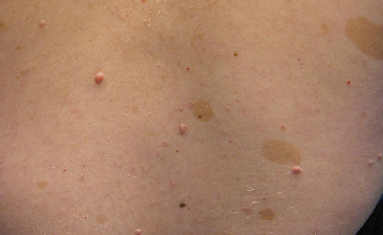 Neurofibromastosis. Mltiples neurofibfromas de pequeo tamao y mltiples manchas cafe con leche