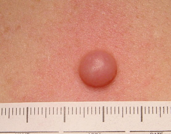 Neurofibroma solitario