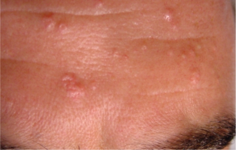 Hiperplasia seb�cea. M�ltiples papulas amarillentas, umbilicadas centralmente con peque�as telangiectasias