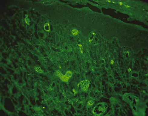 IFD de vasculitis leucocitoclstica mostrando depositos de inmunoreactantes en vasos de dermis papilar. (JJAD 2001)