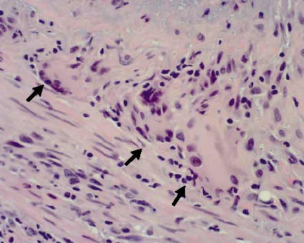 Histologa de la arteritis temporal.  Un 50% de pacientes muestra en la biopsia inflamacin granulomatosa con presencia de clulas gigantes multinucleadas en la unin entre la media y la ntima. Savarini C y col. NEJm 2002 347:261.