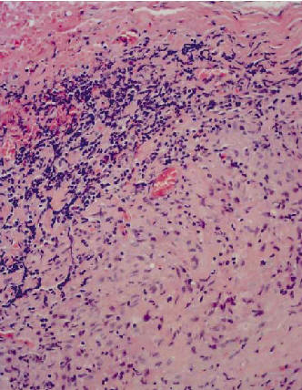 Histologa de la arteritis temporal. Inflamacin Infiltrado inflamatorio de predominio linfoctico. Savarini C y col. NEJm 2002 347:261