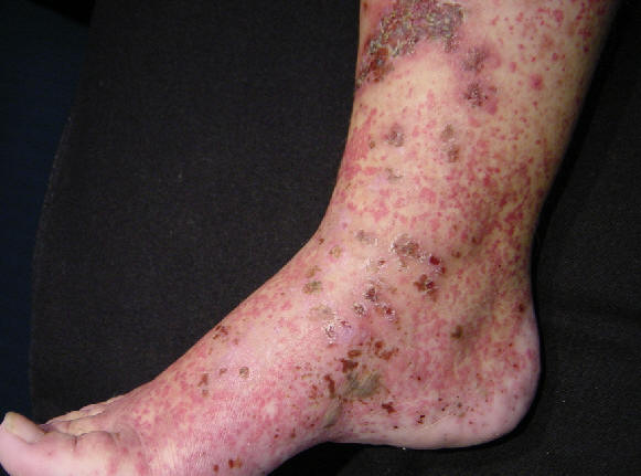 Lesiones de púrpura palpable en una paciente con vasculitis leucocitoclásica. Clinicamente se observan lesiones purpuricas, sobrelevadas, algunas de ellas han evolucionado hacia la formación de vesiculas y ampollas.