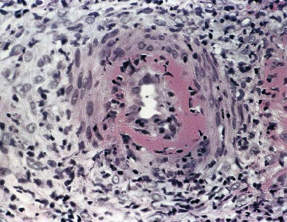 Vasclitis de arteria muscular en la unión dermo-hipodérmica en un paciente con poliarteritis nodosa. Se observa la presencia de infiltrado en la pared del vaso y de necrosis fibrinoide(provost TT. Cutaneous medicine)