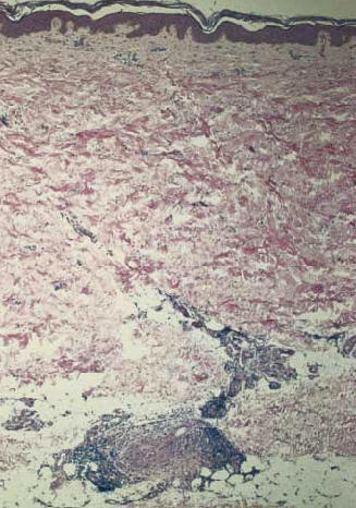Vasculitis de una arteria muscular localizada en la unin dermo-hipodrmica en un paciente con poliarteritis nodosa(provost TT. Cutaneous medicine)