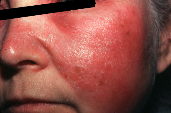 erisipela facial (www.emedicine.com)