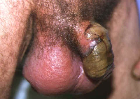 Gangrena de Fournier. Imagenes de Dr. M Navarro. S. Dermatologa. HGV.